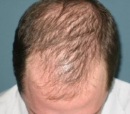 Alopecia - Farmacia Blasco
